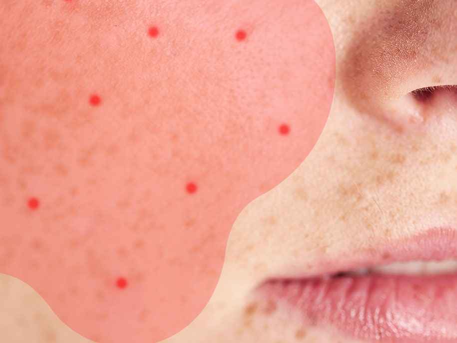 Comment savoir si votre « acné » pourrait en fait être une rosacée