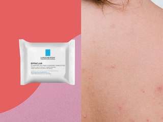 6 produits que les dermatologues recommandent pour l'acné corporelle
