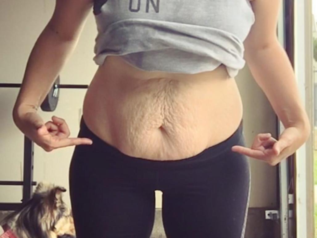 17 femmes partagent des photos de peau lâche après une perte de poids pour prouver à quel point elle est courante et normale