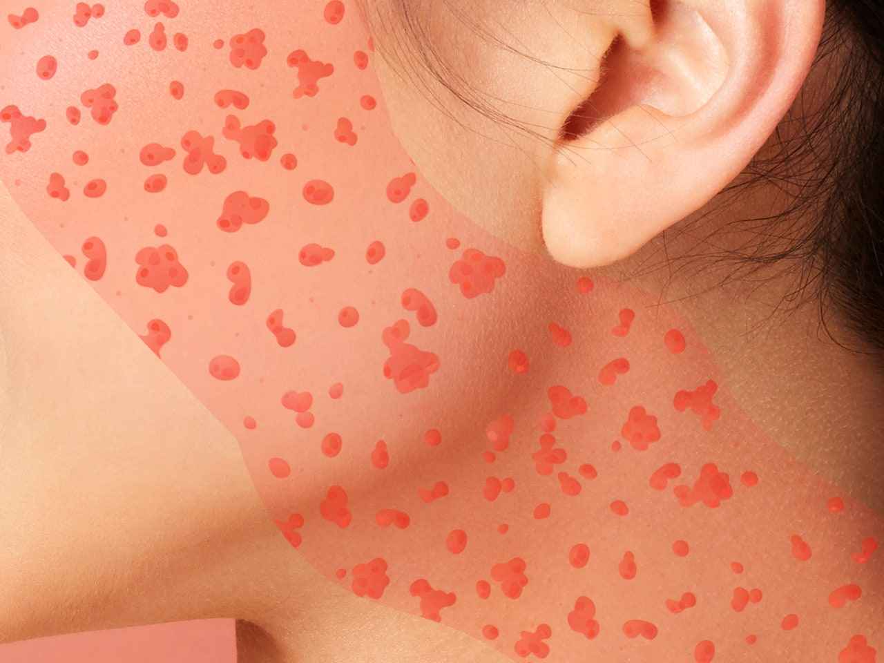 Comment prendre soin de votre peau en colère après une réaction allergique sur votre visage